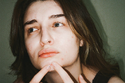 אקנה בדרך הטבעית